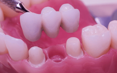 Types of Dental Bridges | Which One is Right for You?