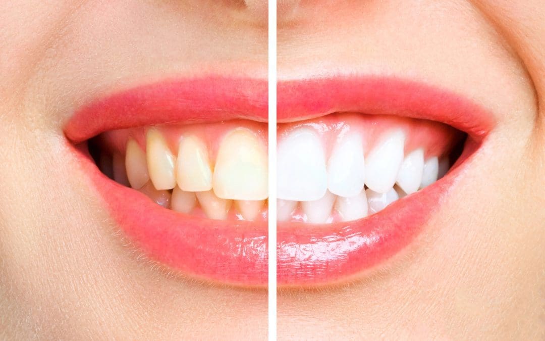 Teeth Whitening Arlington | Expert Tips & Best Choices Near You