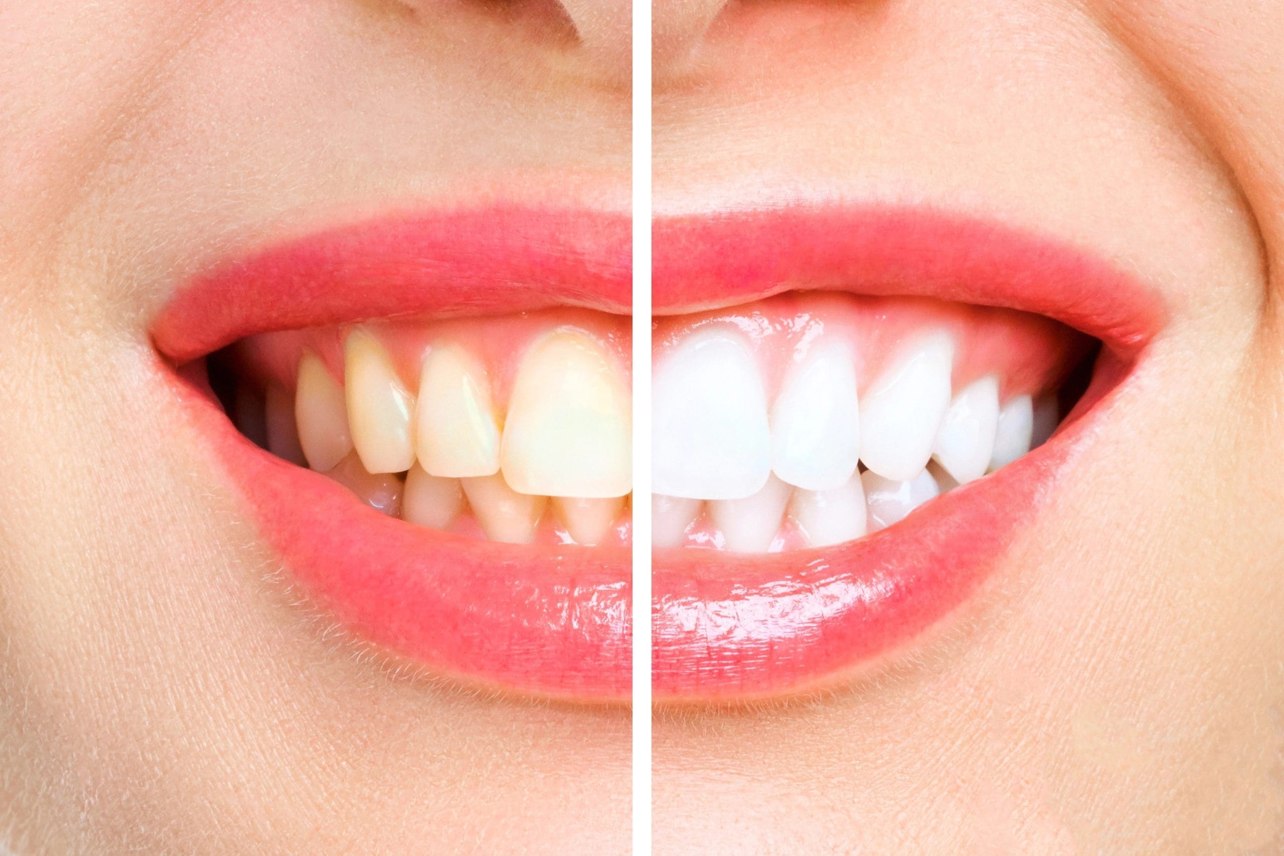 Teeth Whitening Arlington at Advance Dental Care Center. Contact 703-415-0505 for expert advice.