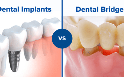 Dental Bridge vs Implant | A Complete Comparison