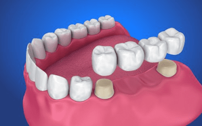 Affordable Dental Bridges Arlington | Find the Best Deals