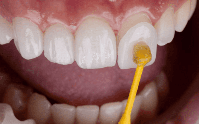 Are Veneers Permanent? Everything You Need to Know About Lifespan