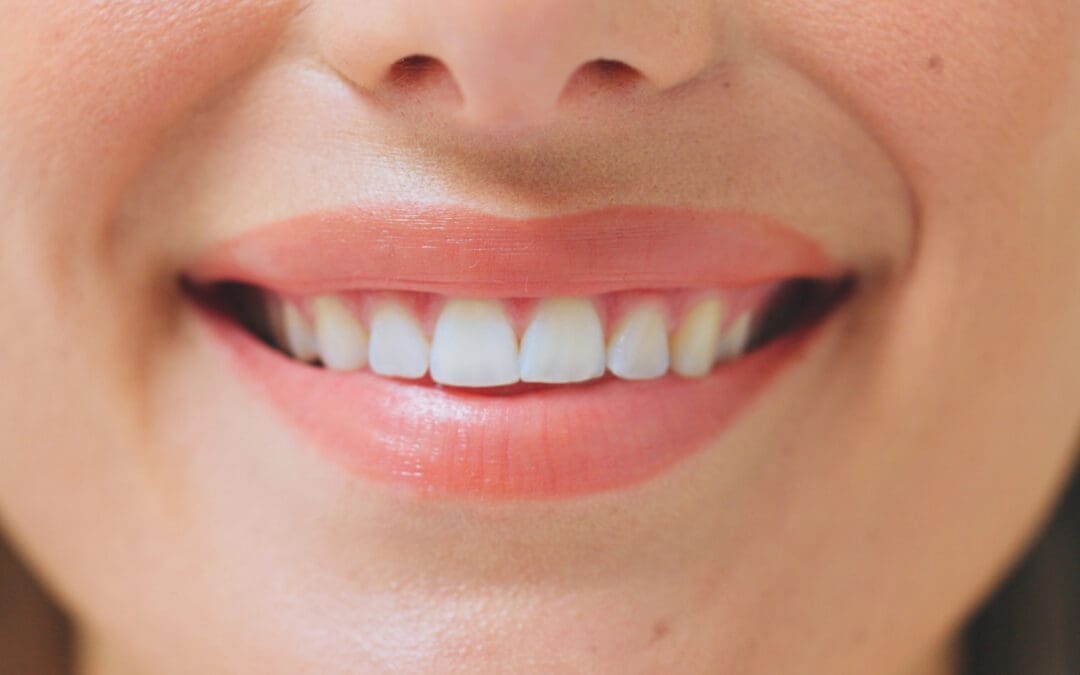 Pros and Cons of Veneers: Key Factors to Consider Beforehand