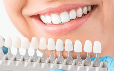 Dental Veneers Cost: Understanding Prices and What to Expect