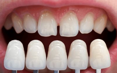 How Are Veneers Done? Step-by-Step Guide to the Procedure